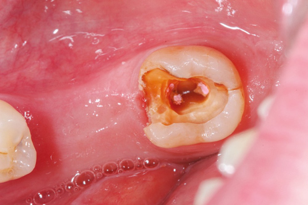 découvrez tout ce qu'il faut savoir sur l'arrachement des dents mobiles : processus, soins post-opératoires et conseils pour une guérison rapide. informez-vous sur cette intervention courante et ses implications pour votre santé bucco-dentaire.